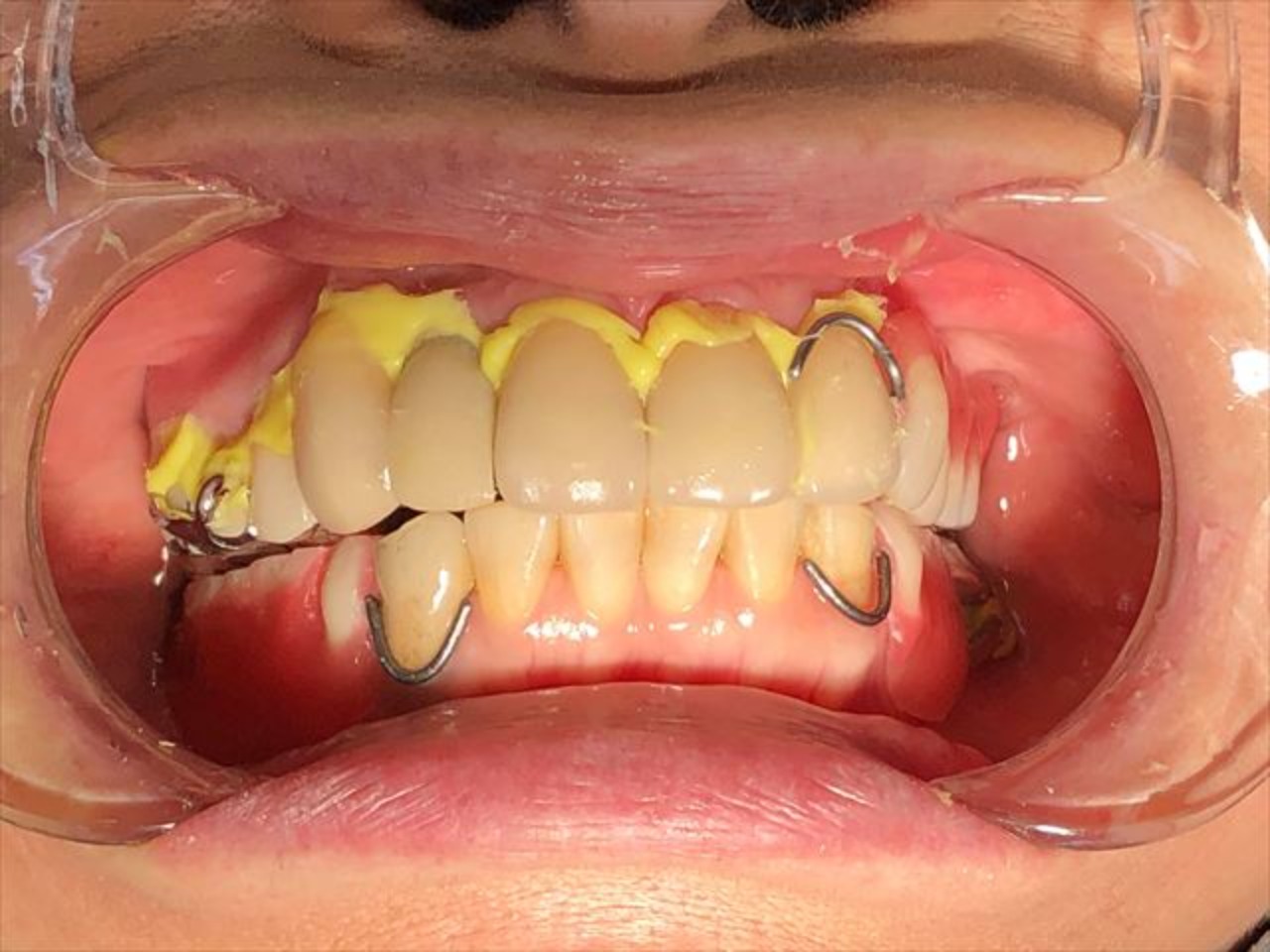 誰にでもできる咬合採得 51wUIjyOkHL.jpg