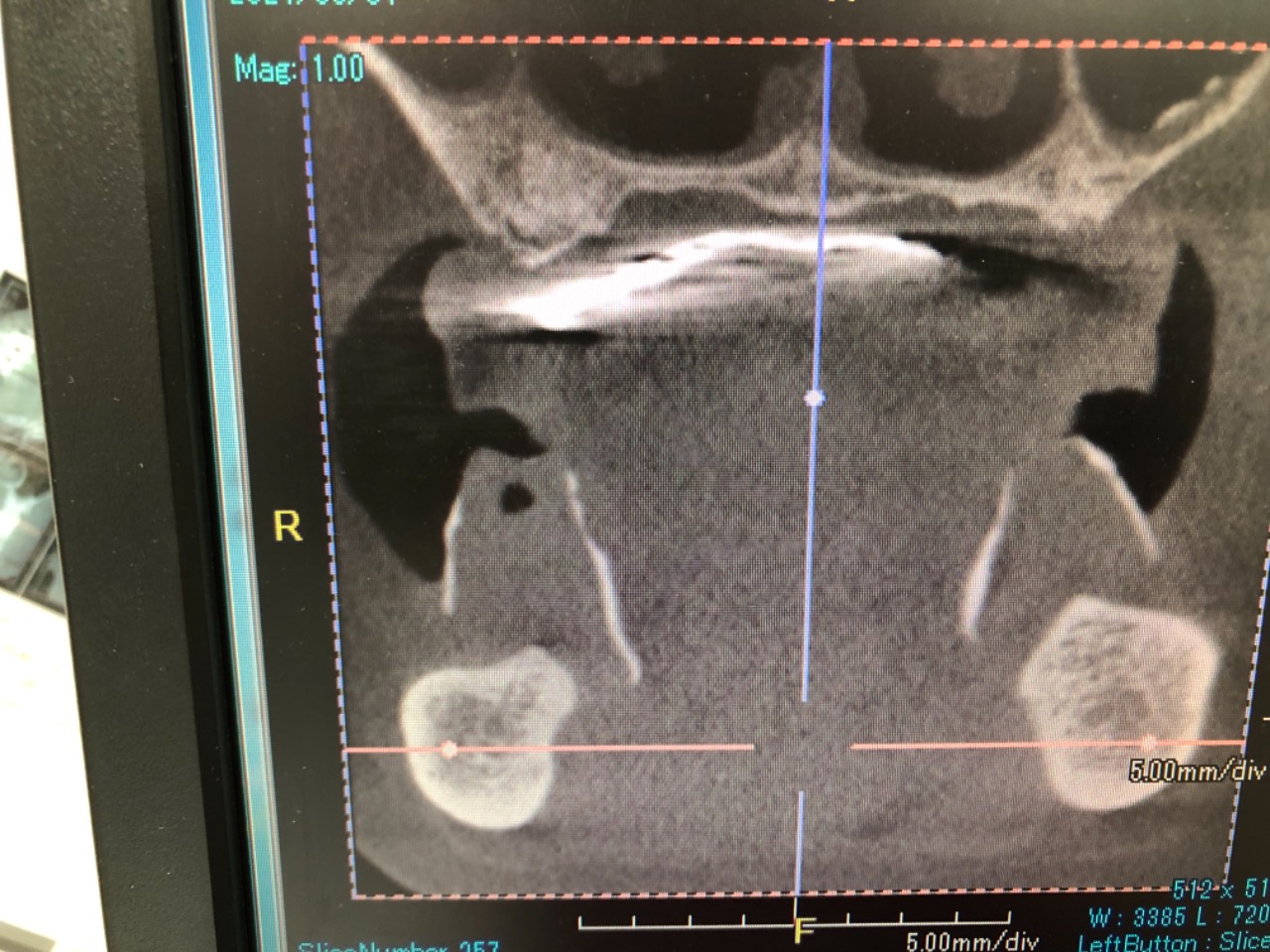 インプラント埋入時期のニュートラルゾーンの確認法 | GDS:歯科医を